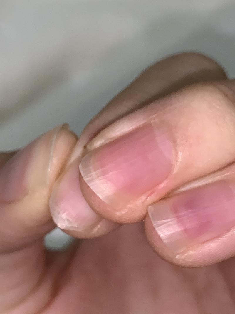 이게 보기보다 깊어;; 네이버에 갑자기 살이 잘림 베임 쳐도 안나오고 아니 어캐 이렇게되지