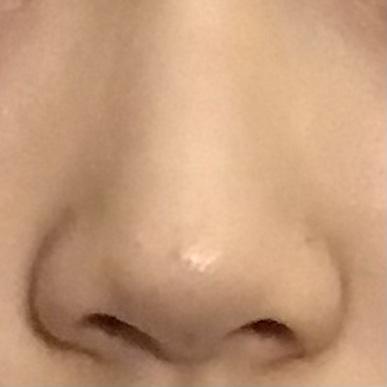 가뜩이나 코에 이것저것 나서 스트레스받는다 코 수술 하고 싶은데 부작용도 무섭고 티 날까바 ㅠㅠ