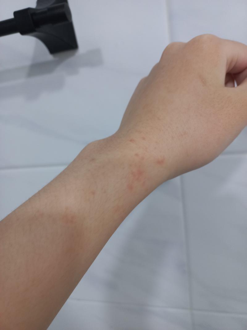 헹 목욕하던 중 깨달았어 근데 보니까 약간 두드러기나 발진같아보이네