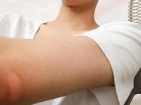 깜짝아 순간 내 사진인 줄 균이구나… 들어가 보니 모기였는지 벌레여ㅛ는지 아무튼 물렸을 때 사진이네