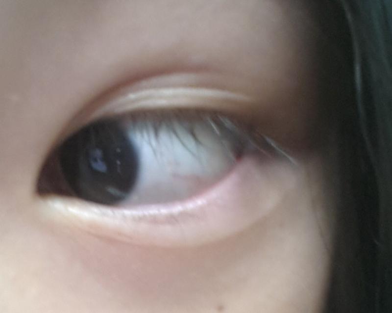 쌍꺼풀 말고 삼꺼풀