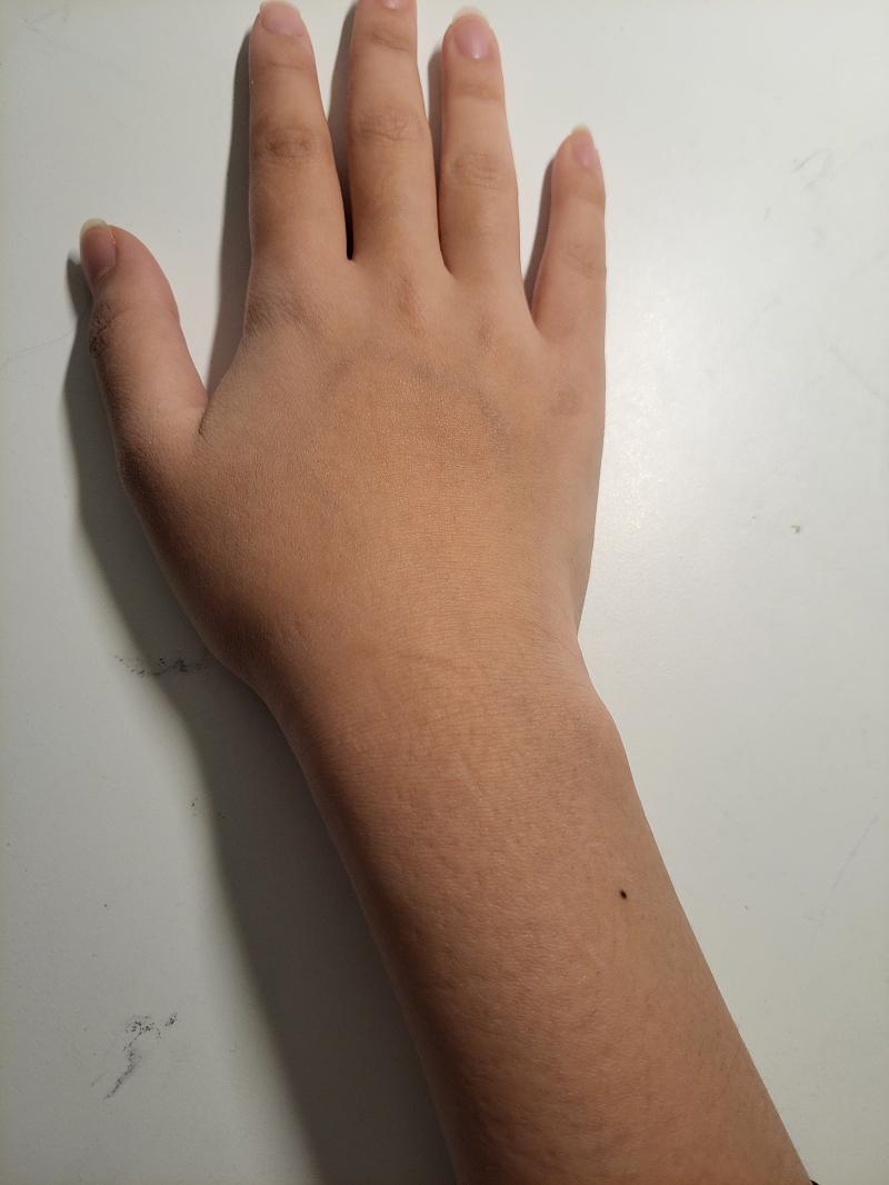 자고일어난 결과. (오른손을 다쳤음.) 1시 20분쯤에 다시 찬물로 수건 적시고 압박한 상태에서 잤는데, 다음날 되니까 꽤 많이 괜찮아짐. 멍은