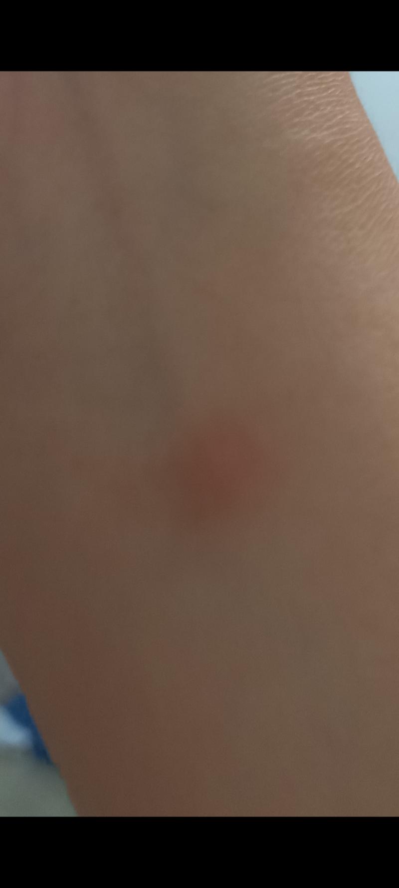 어제랑 이틀 전 지독한 모기의 습격을 받음;;;;. 심지어 이미 물린곳에 한방 더 물려서 갈고리 모양이야!! 간지러워 죽는 줄 어제는 진짜 심각