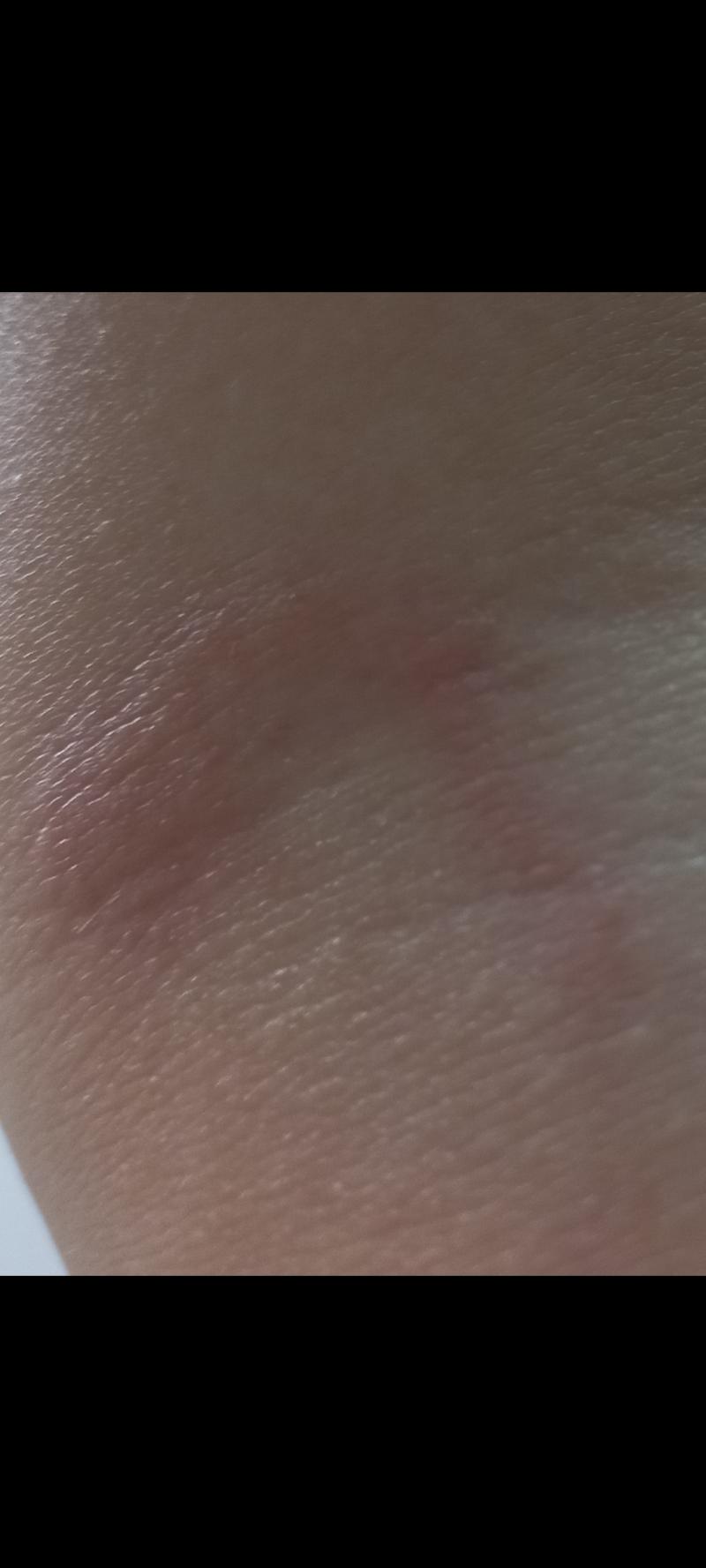 어제랑 이틀 전 지독한 모기의 습격을 받음;;;;. 심지어 이미 물린곳에 한방 더 물려서 갈고리 모양이야!! 간지러워 죽는 줄 어제는 진짜 심각