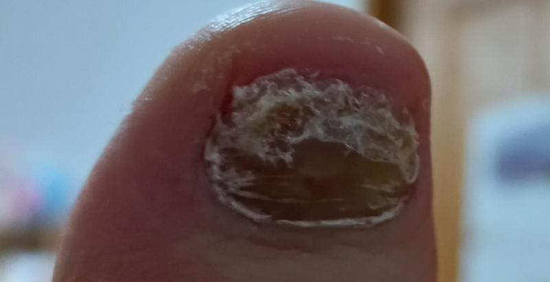 발톱이 조금... 두껍게 자라서 겉표면 좀 벗겨내고 깎았거든... 발가락도 간지럽고 한데 무좀 같아서 병원에 가봐야할까?