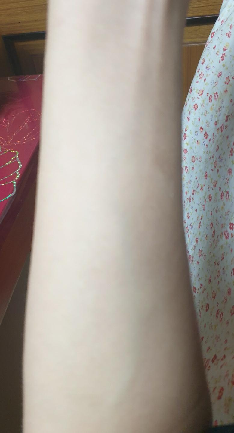 어젯밤에 왼팔에 뭐 났어... 1번사진이 왼팔이고 2번 사진이 멀쩡한 오른팔이야ㅠ 이게 뭔지 잘 모르겠는데 알레르기나 두드러기같은걸까ㅠㅠㅠ 혹시