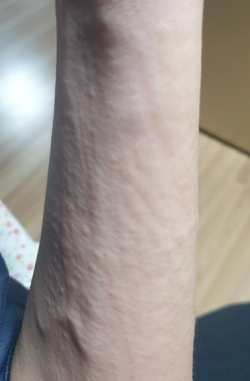 어젯밤에 왼팔에 뭐 났어... 1번사진이 왼팔이고 2번 사진이 멀쩡한 오른팔이야ㅠ 이게 뭔지 잘 모르겠는데 알레르기나 두드러기같은걸까ㅠㅠㅠ 혹시