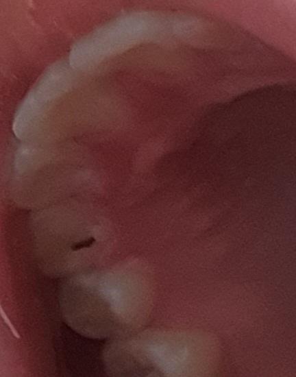 보이는 점 이 충치