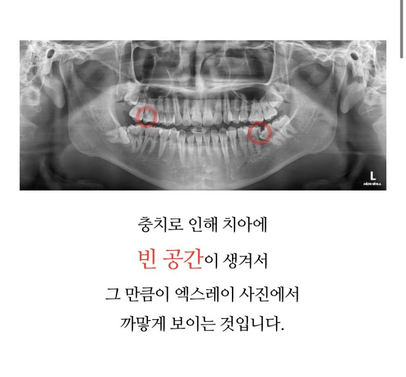 >>4 충치 까맣게 되어 잇엉 투명한데 까맣게? 빈공간 때문에 그런거라 하넹