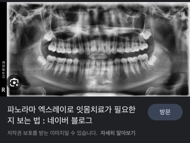 >>5 막 심하게 녹아내리지 않는 이상 잘 모르지 않을까? 잇몸은 육안으로 봐야할 거 같은데 관련 직종은 아니라 잘 모르겠다ㅠㅠ 근데 잇몸은 이