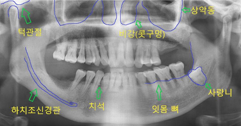 >>7 잇몸 살은 엑스레이상으로 안 나오고 잇몸뼈만 나오는 거 같지않아? 다 비워져 있던데... 사진은 네이버꺼 내 엑스레이 사진이랑도 비교 해