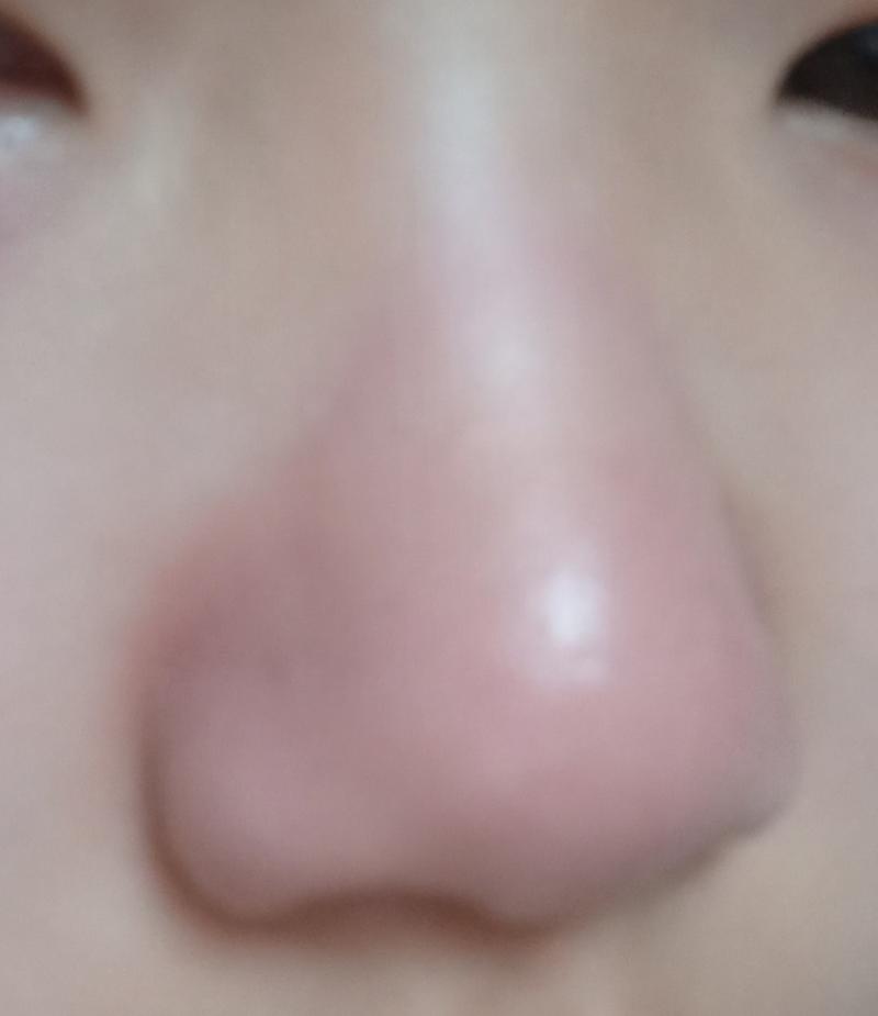 근데 이이이렇게 되버린겨 갑자기 콧망울..? 콧등?? 이 생겨버림