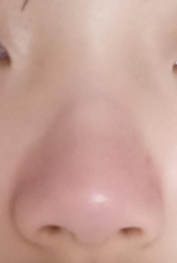 근데 이이이렇게 되버린겨 갑자기 콧망울..? 콧등?? 이 생겨버림