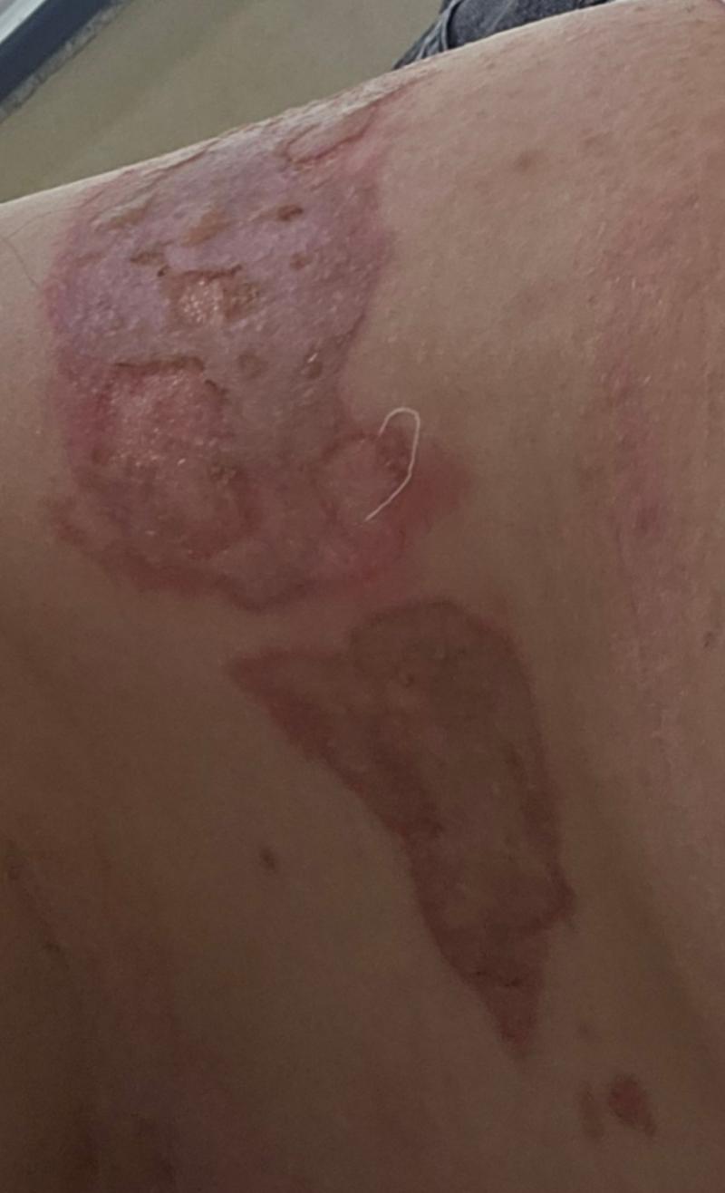 (사진혐 주의) 생각보다 상처 너무 심한데... 흉터없이 나을수 있을까..
