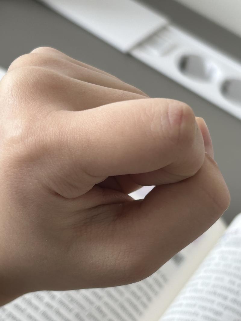 손가락염좌도 걸릴 수 있나요? 빨갛게 됏는데 움직일때마다 아프ㅁ니다.. 그냥멍든걸까요