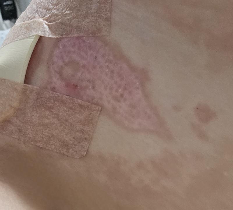 ⚠️ 혐주의 그래도 상처 많이 옅어졌당 흉은 평생 안고 살아야 할거고, 메디폼 고정용으로 붙여둔 밴드에 알러지 올라와서 피부가 얼룩덜룩 난리도 