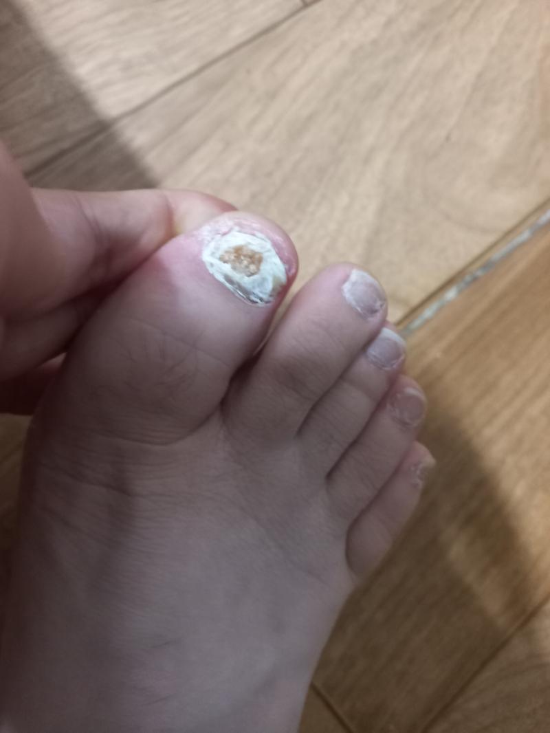 발톱 무좀 벗겨내다 이리 된 건데 발가락 잘라야할까봐 겁남