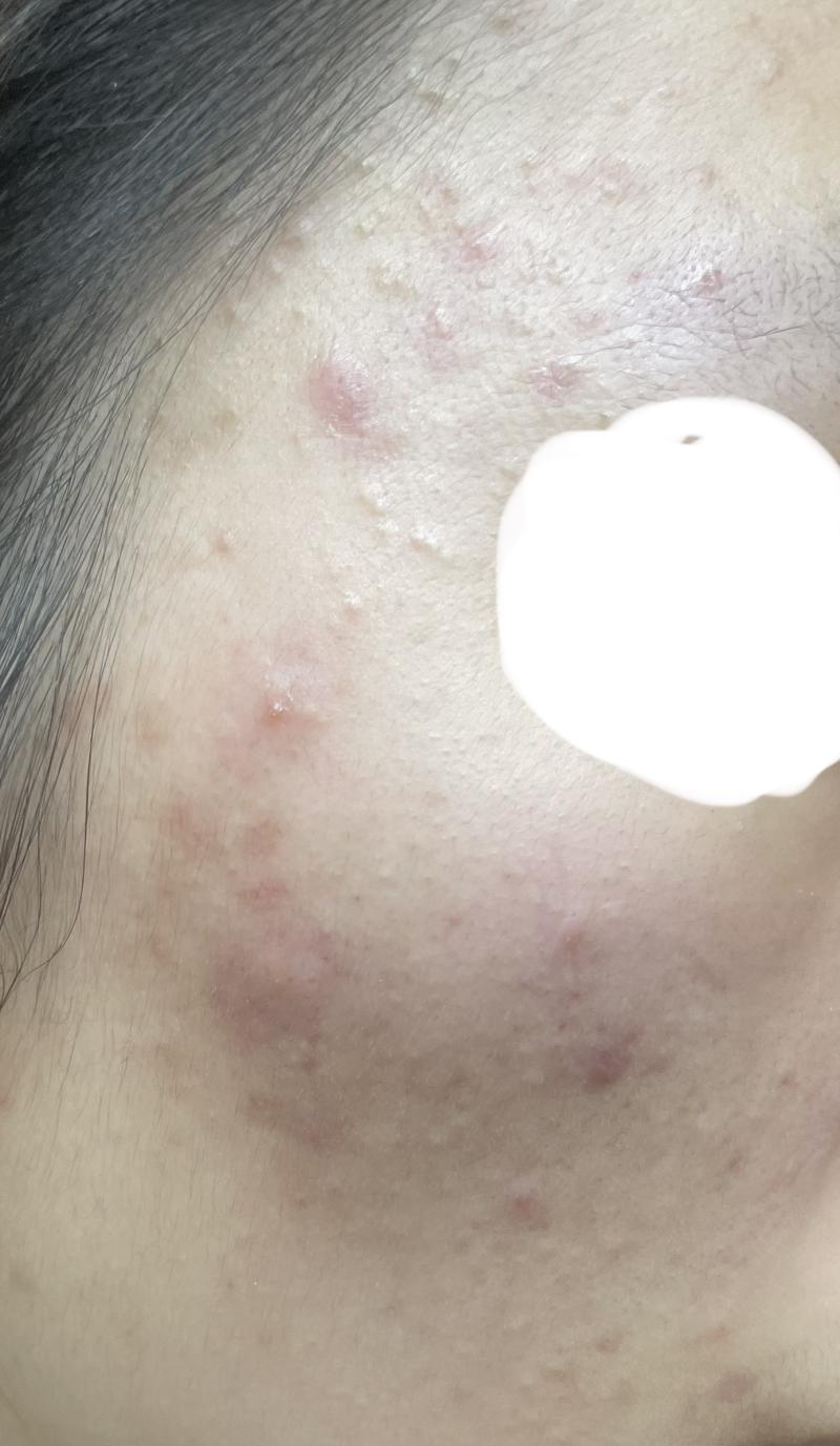 관자놀이쪽이특히 두드러지게 심함 ㅠㅜㅠㅠ