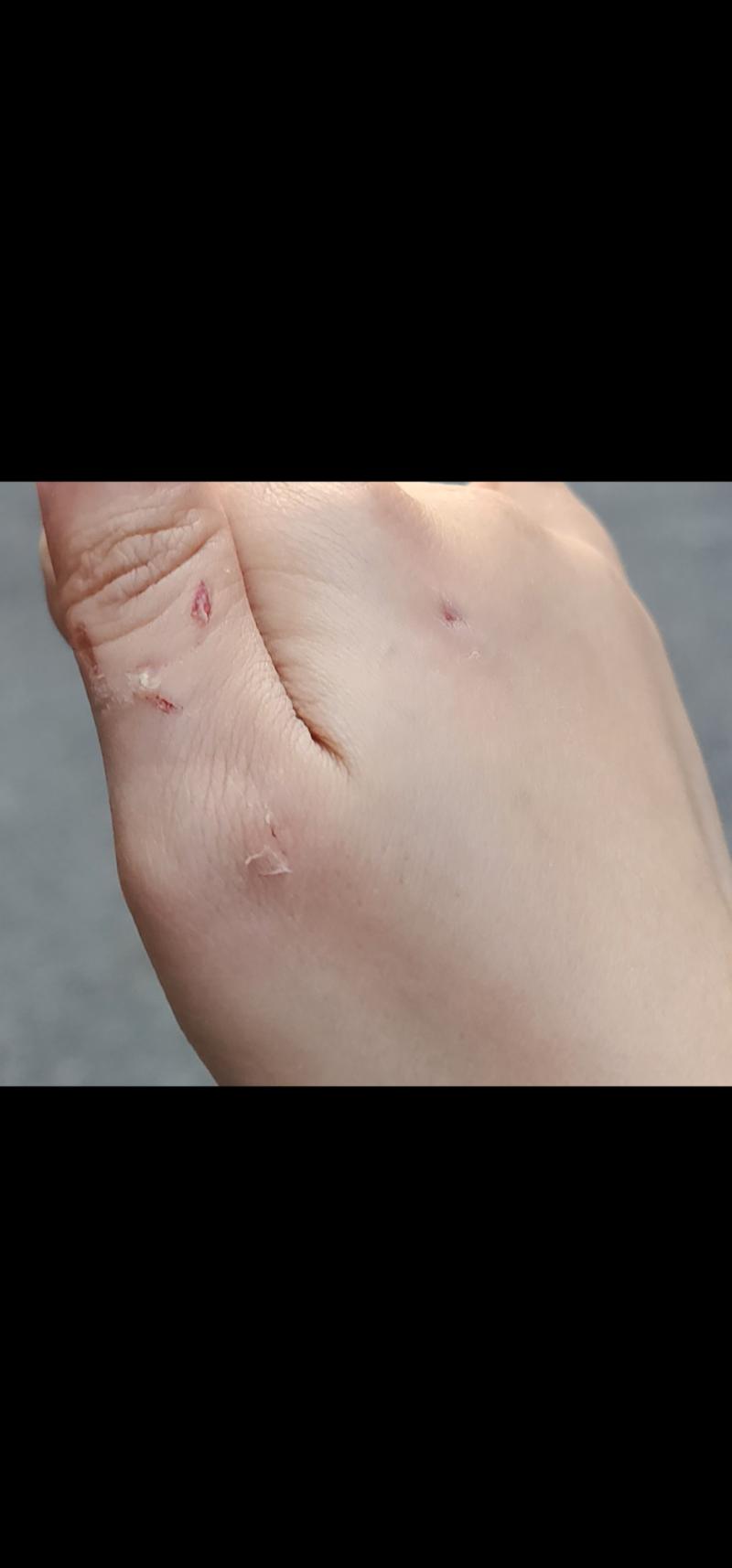 다쳣서...... 지인 반려동물한테 물어뜯겻서...... 나는 밥 주려 했는데ㅠ 진짜 억울함. 지인이 부탁해서 휴식때 갔는데 처음이라 허둥댈 수