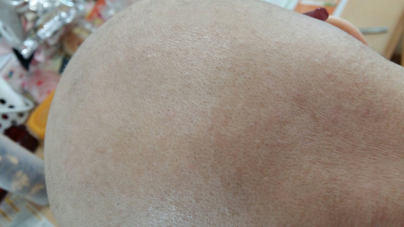 처음 시작은 역시 그냥 원형탈모 정도였어. 난 지금 93년생이라 30대 중반인데 고 2 올라갈 때부터 탈모가 시작됐거든. 그 땐 그냥 평소보다