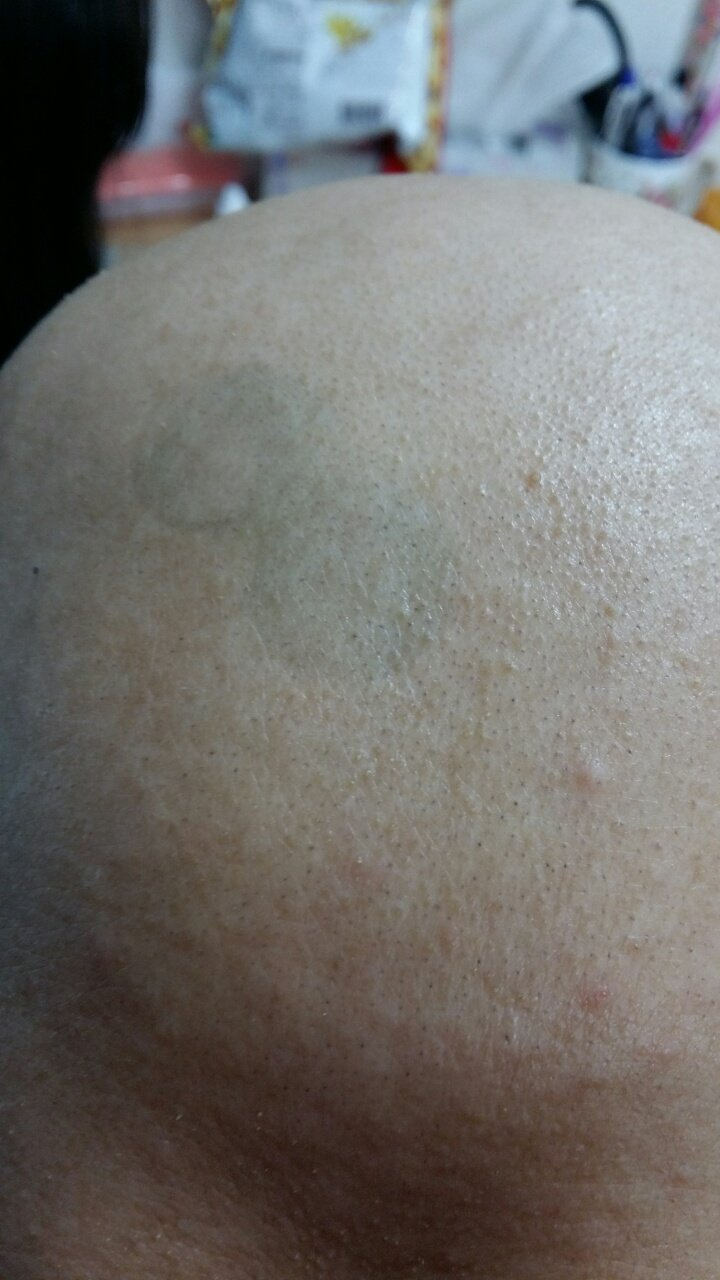 처음 시작은 역시 그냥 원형탈모 정도였어. 난 지금 93년생이라 30대 중반인데 고 2 올라갈 때부터 탈모가 시작됐거든. 그 땐 그냥 평소보다