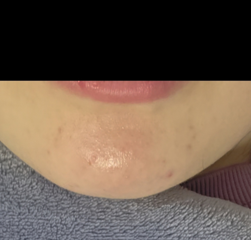 진짜 오랜만에 갱신 하는데 역시 여드름은 시간이 답이고 마데카 크림은 신이라고 깨닫는데 년정도 걸림 지금은 색소침착도 거의 옅어졌고 겨울이라 그런지 여드름도 안남 여름 되면