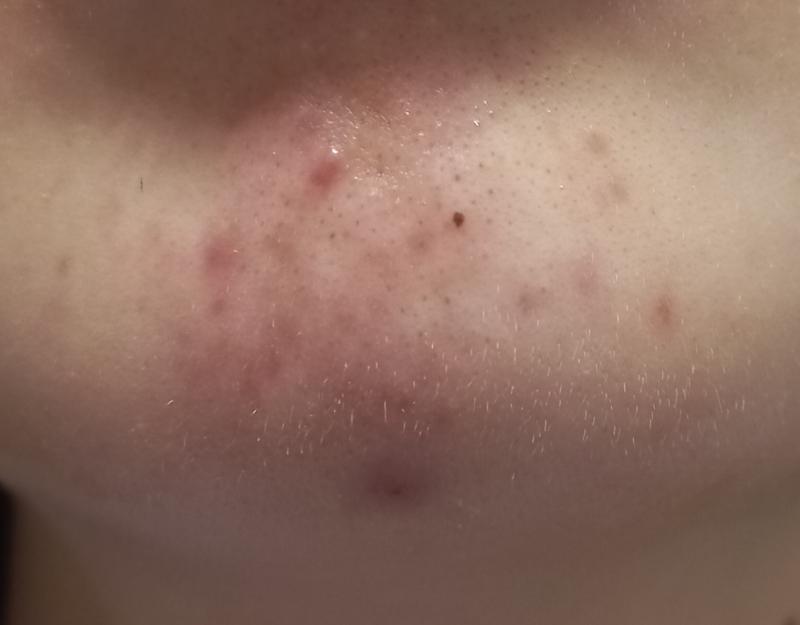 일차 토너 파티온 노스카나인 트러블 클리어 토너 크림 아템포 개똥쑥 수분 크림 씻고 찍었더니 붉어진 느낌 일단 피부 과영양 온거 같아서 두개만 쓰는