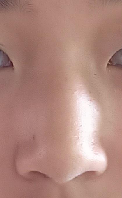 콧볼 넓고 매부리코임 근데 복코로 보여서 어떻게 해야하지 눈도 눈이고 얼굴형도 얼굴형인데 때문에 촌스러워보이는