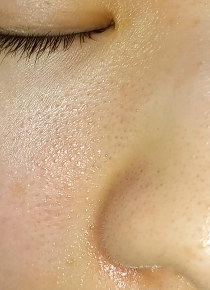 일차 토너 파티온 노스카나인 트러블 클리어 토너 크림 아템포 개똥쑥 수분크림 하도 레티놀이랑 아침에도 비타민이랑 아젤라인산 발라서 그런지 얼굴이 너무 붉어져서 두개만 바름 피부가