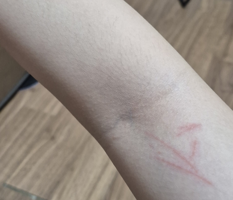아니 팔이왜케따갑지 하고 보니까 내가 벅벅긁엇는지 상처나잇음