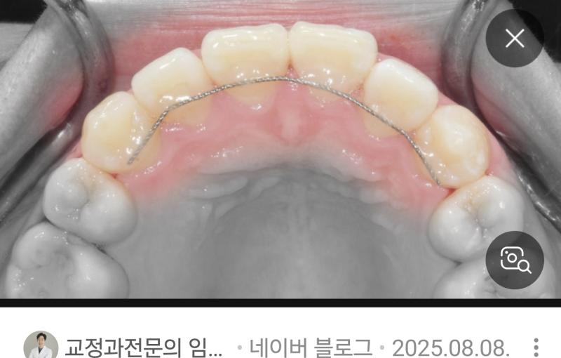 꼈다뺐다 하는건 잘때만 하면 되니까 그렇다 쳐도 이거 철사 평생 붙여야 한다던데 다들 별로 불편해 느낌도 안난다는 사람도 있던데 나는 울퉁불퉁하고 혀에 너무 거슬리거든 다들