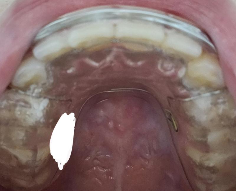 오랜만이네 드디어 교정기 풀었다 오늘 수능 전날이라 학교 쉬어서 치과 다녀왔는데 몇주 전에 유지장치 뜬거 오늘 받아왔어 근데 껴보고 뜨악함 생긴거 궁금할까봐 사진두 올리는데 이름